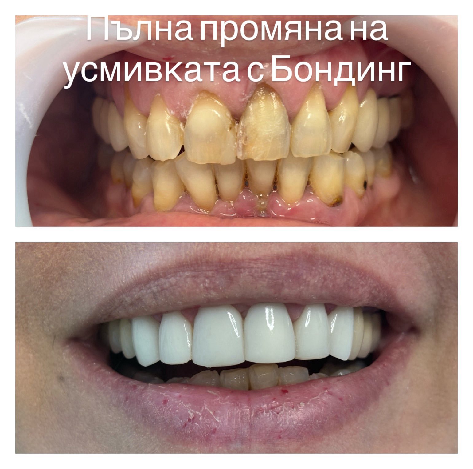 Бондинг на зъби резултат — зъболекар дентална практика Варна, Топ Дент
