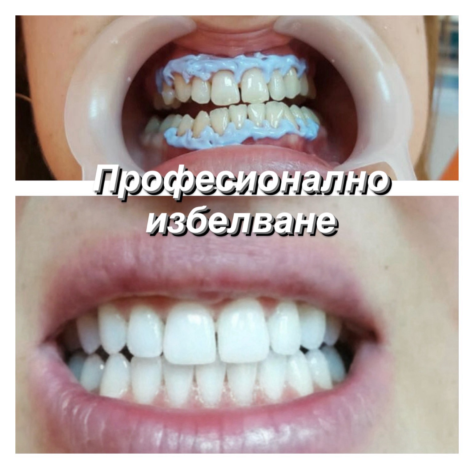 Избелване на зъби преди и след — дентален кабинет Топ Дент Варна, д-р Тихола Захариева, зъболекар