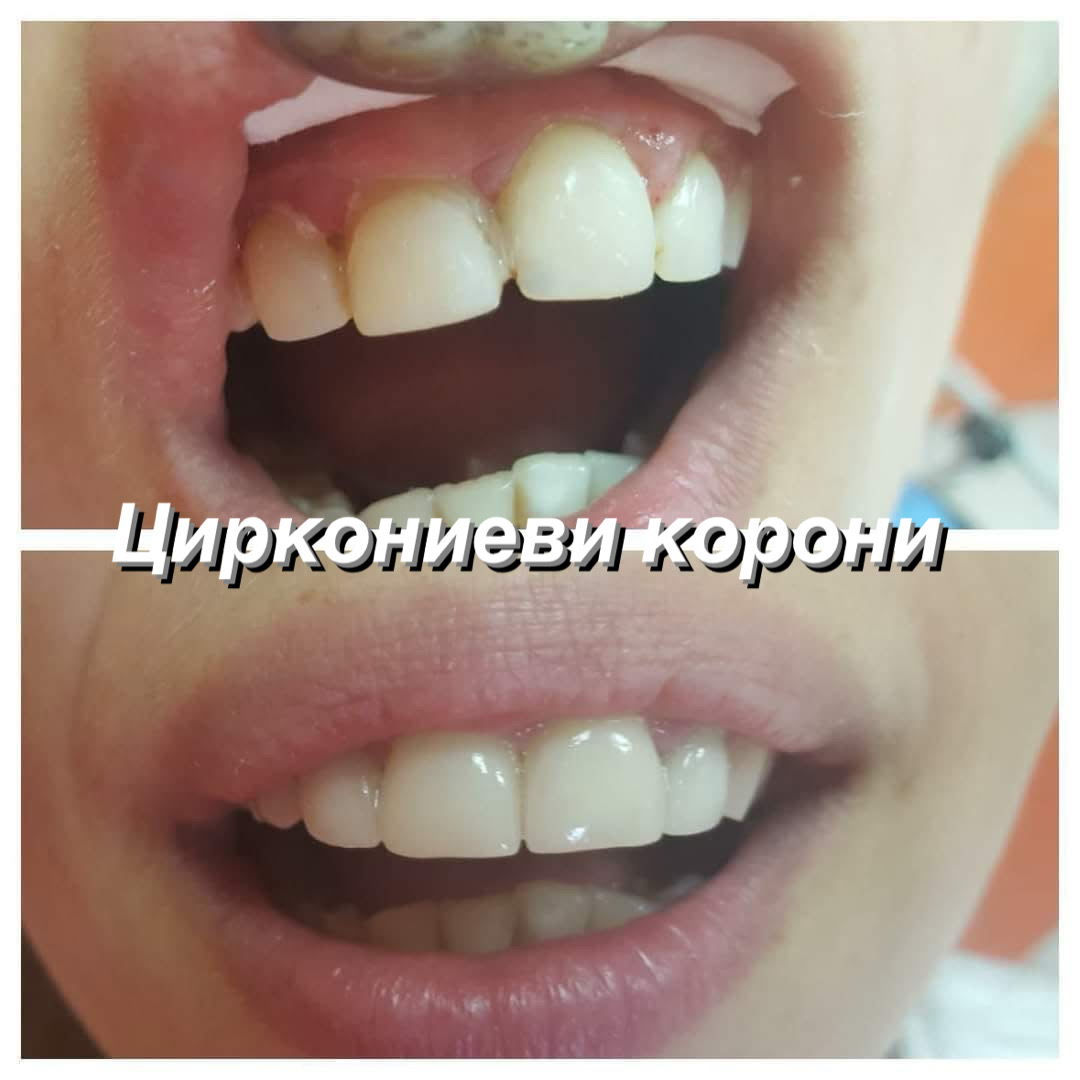 Циркониева корона преди и след — дентална практика Топ Дент Варна, д-р Захариева, зъболекар Варна